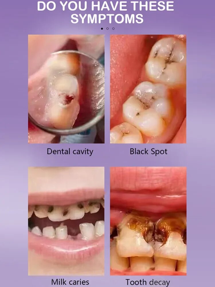 V34 Tooth decay repair Repair all tooth decay cavities and protect teeth Removal of Plaque Stains Decay Repair Teeth Whitening Maintain Beauty Store